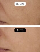 Cocunat Clinical Beauty Filler sérum proti stárnutí pleti s mikrojehličkováním 5 ml