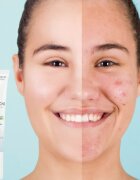 Dermedic Normacne Therapy lokální péče proti akné 15 g