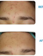 Dermedic Redness Calm krém proti zarudnutí a rozšířeným žilkám 40 ml