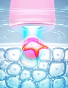 FOREO ESPADA™ 2 pero s modrým světlem pro zmírnění projevů akné Pearl Pink 1 ks