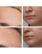 FOREO KIWI™ Derma zařízení pro diamantovou mikrodermabrazi a čištění pórů 1 ks