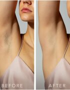 FOREO PEACH™ 2 IPL systém prevence růstu nových chloupků Peach 1 ks