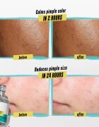 Kiehl's Dermatologist Solutions Truly Targeted Blemish-Clearing Solution sérum na aknózní pleť pro ženy 15 ml