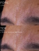 Lancôme Rénergie CRX Triple Serum Retinol pleťové sérum 20 ml