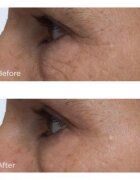 Perricone MD Cold Plasma Plus+ Eye Cream vyživující oční krém proti otokům a tmavým kruhům 15 ml