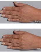 Perricone MD Cold Plasma Plus+ Hand Therapy pečující krém na ruce 59 ml