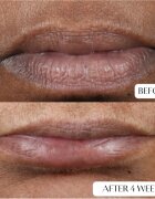 Perricone MD Cold Plasma Plus+ Lip Therapy vyživující a hydratační balzám na rty 4 ml