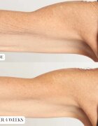 Perricone MD High Potency Intensive Body Therapy intenzivní vyživující krém na tělo 177 ml