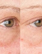 Perricone MD Hypoallergenic Clean Correction Eye Cream hydratační a rozjasňující péče na oční víčka a kruhy pod očima 15 ml