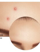 Revox B77 Zitcare AHA BHA PHA Spot Treatment lokální péče proti akné 25 ml