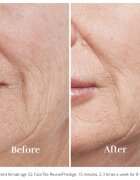 Silk'n FaceTite Essential přístroj pro revitalizaci a omlazení pleti 1 ks