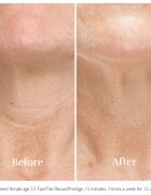 Silk'n FaceTite Essential přístroj pro revitalizaci a omlazení pleti 1 ks
