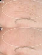 StriVectin Anti-Wrinkle SD Advanced Plus koncentrovaný krém redukující vrásky 118 ml