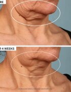 StriVectin Tighten & Lift TL Advanced Tightening Neck Cream Plus liftingový zpevňující krém na krk a dekolt 30 ml