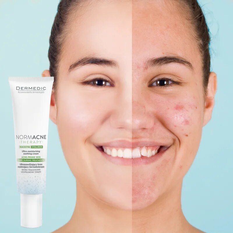Dermedic Normacne Therapy hydratační krém na aknózní pleť 40 ml