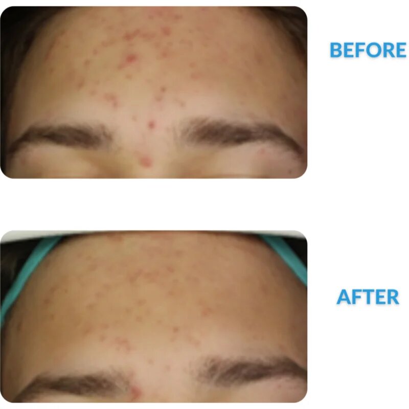 Dermedic Redness Calm krém proti zarudnutí a rozšířeným žilkám 40 ml