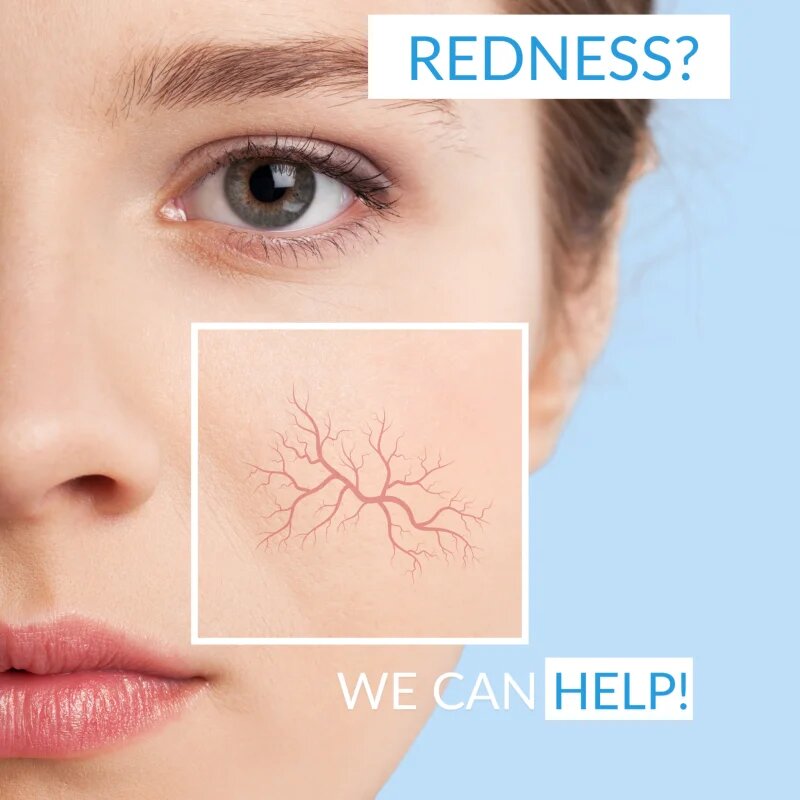 Dermedic Redness Calm zklidňující čisticí pěna 150 ml