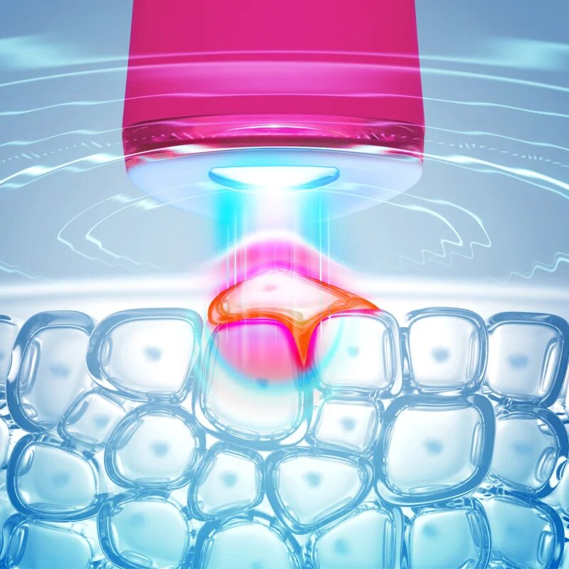 FOREO ESPADA™ 2 pero s modrým světlem pro zmírnění projevů akné Fuchsia 1 ks