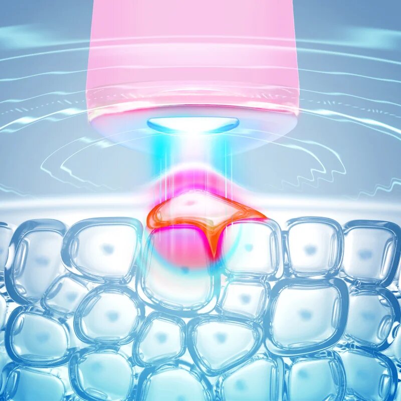 FOREO ESPADA™ 2 pero s modrým světlem pro zmírnění projevů akné Pearl Pink 1 ks
