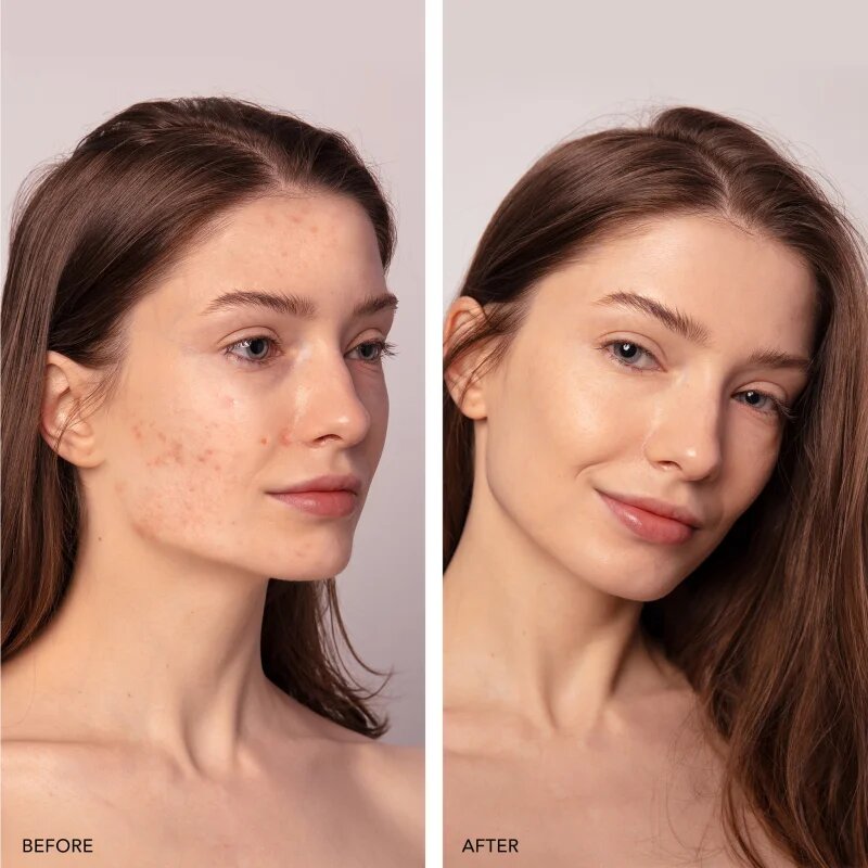 FOREO ESPADA™ 2 Plus pero s modrým světlem pro zmírnění projevů akné Lavender 1 ks