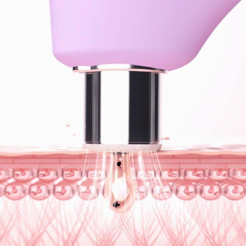 FOREO KIWI™ Derma zařízení pro diamantovou mikrodermabrazi a čištění pórů 1 ks