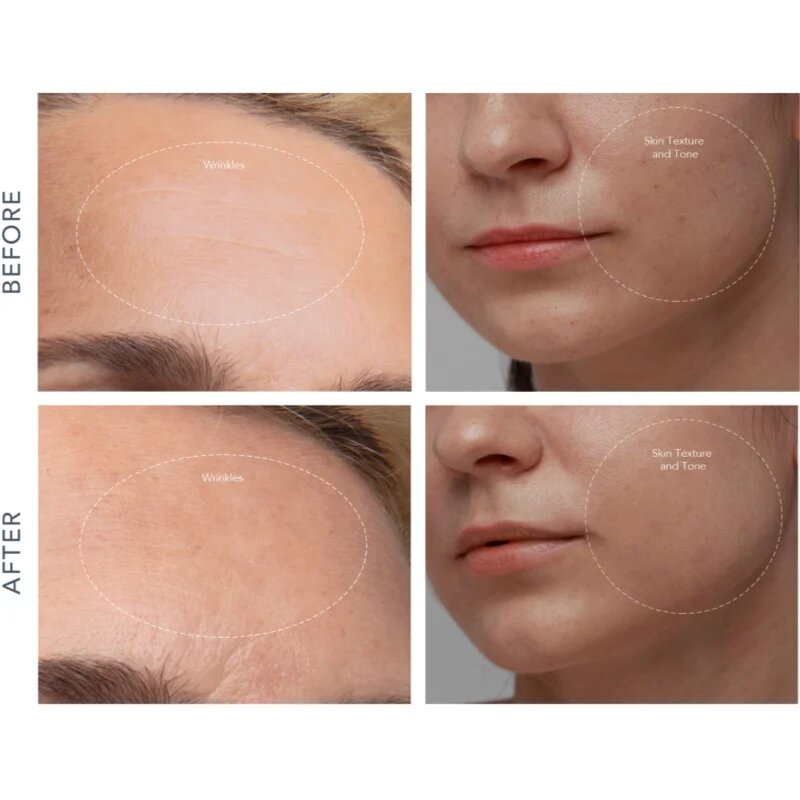 FOREO KIWI™ Derma zařízení pro diamantovou mikrodermabrazi a čištění pórů 1 ks