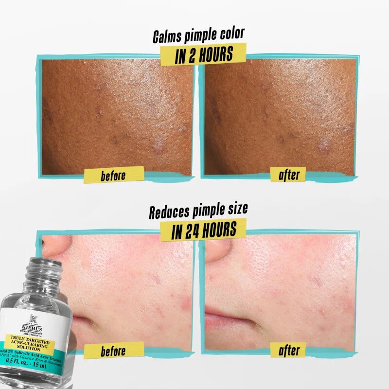 Kiehl's Dermatologist Solutions Truly Targeted Blemish-Clearing Solution sérum na aknózní pleť pro ženy 15 ml