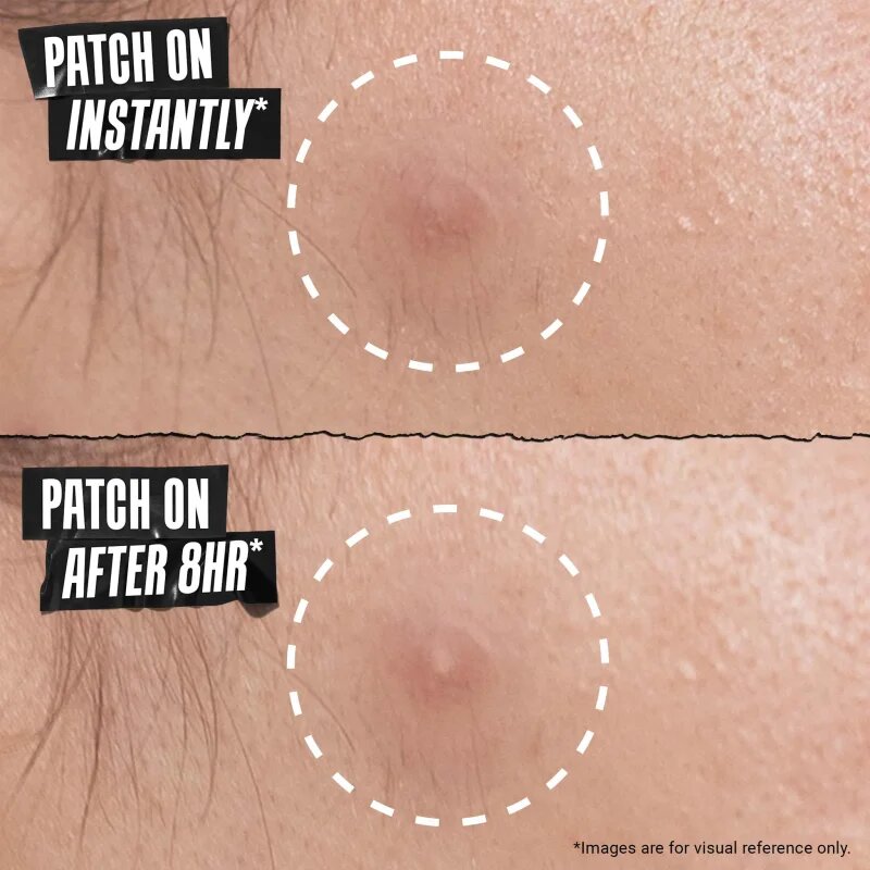 Kiehl's Truly Targeted Overnight Blemish Patch náplasti na problematickou pleť pro ženy 22 ks