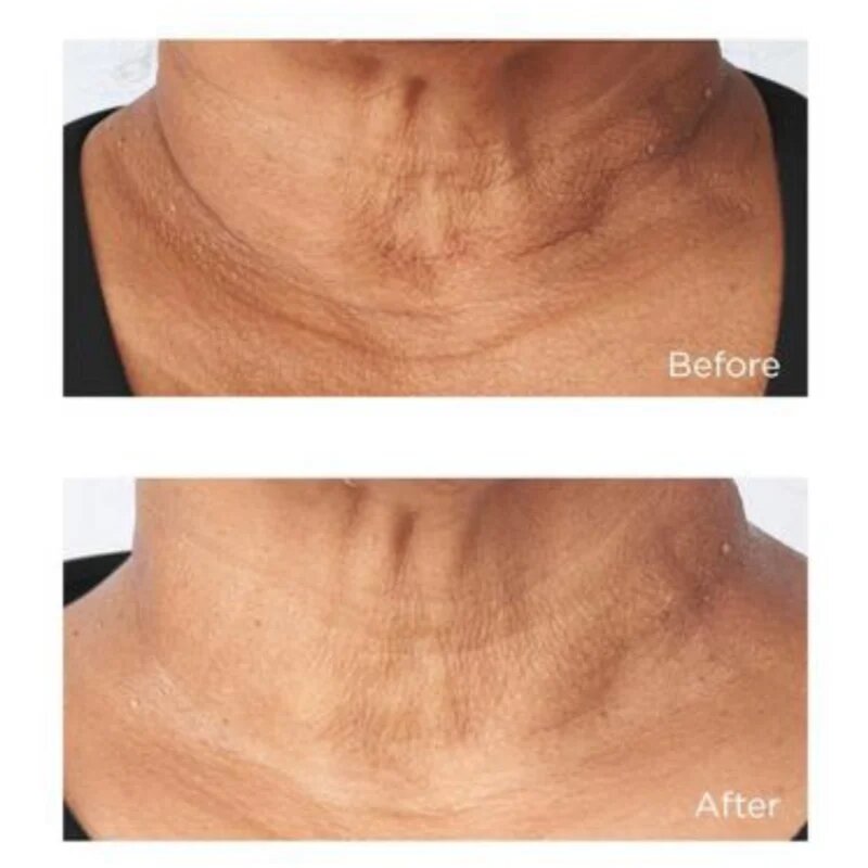 Perricone MD Cold Plasma Plus+ Sub-D/Neck zpevňující krém na krk a dekolt 59 ml