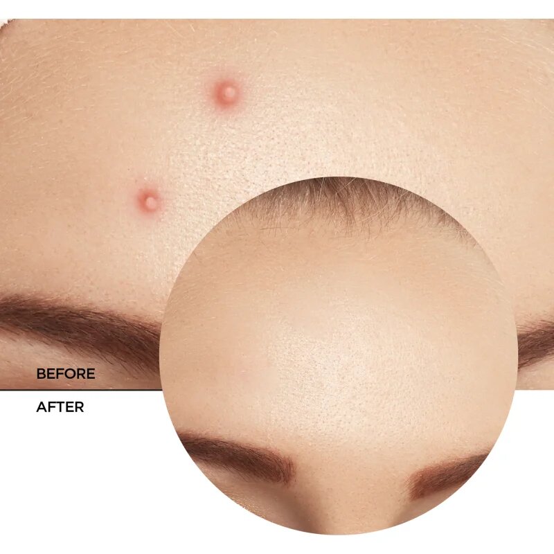 Revox B77 Zitcare AHA BHA PHA Spot Treatment lokální péče proti akné 25 ml