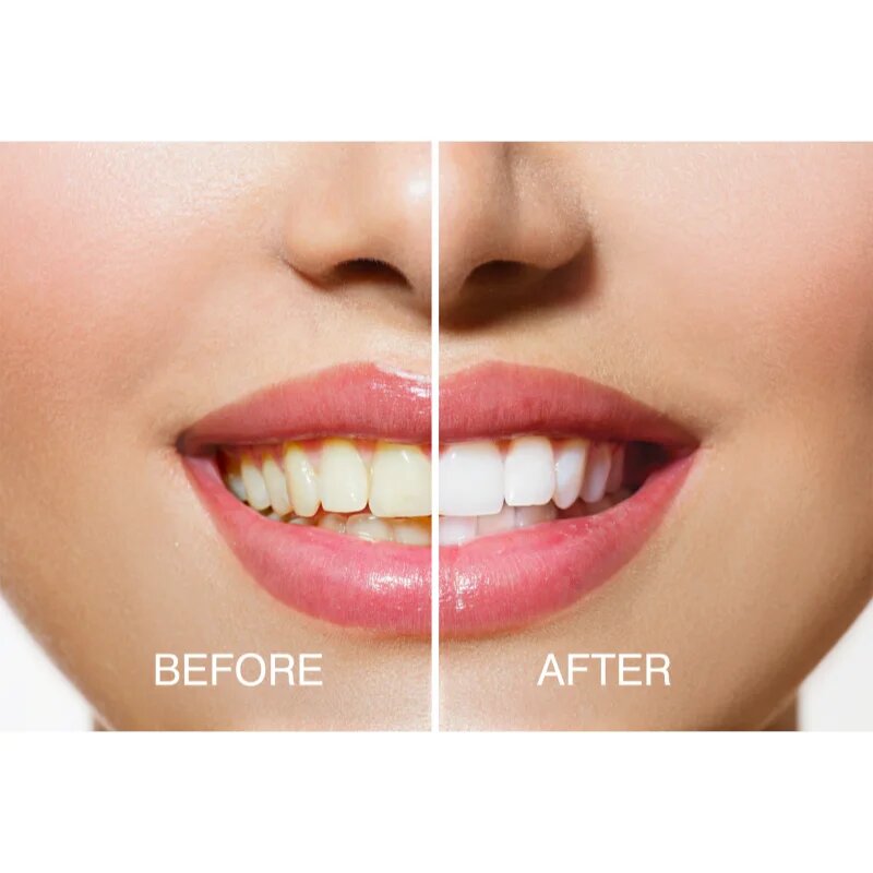 RIO USB teeth whitening sada pro bělení zubů