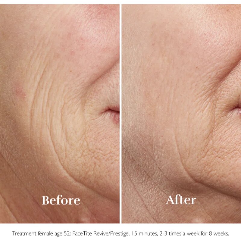 Silk'n FaceTite Essential přístroj pro revitalizaci a omlazení pleti 1 ks
