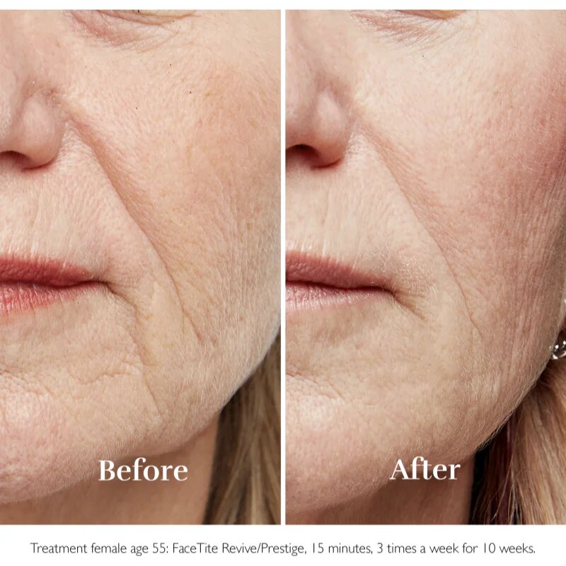 Silk'n FaceTite Essential přístroj pro revitalizaci a omlazení pleti 1 ks