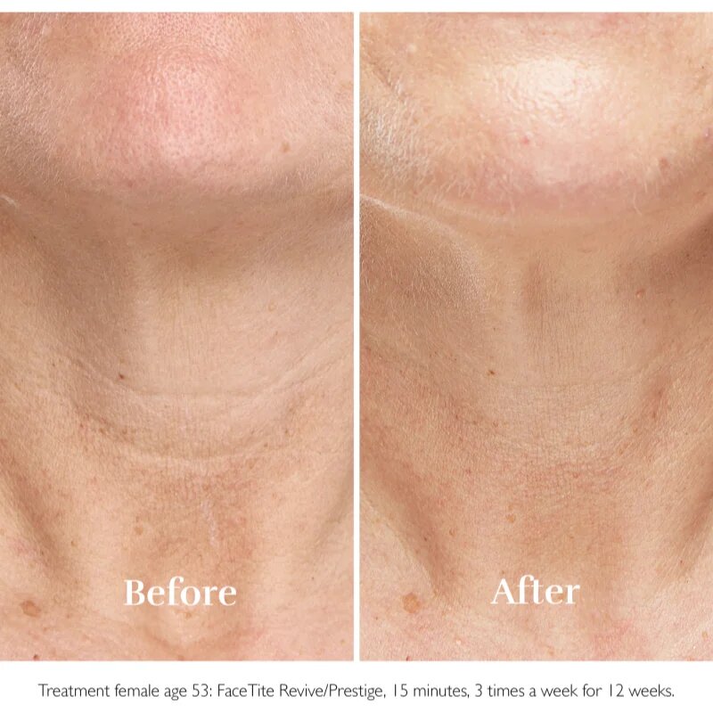 Silk'n FaceTite Essential přístroj pro revitalizaci a omlazení pleti 1 ks