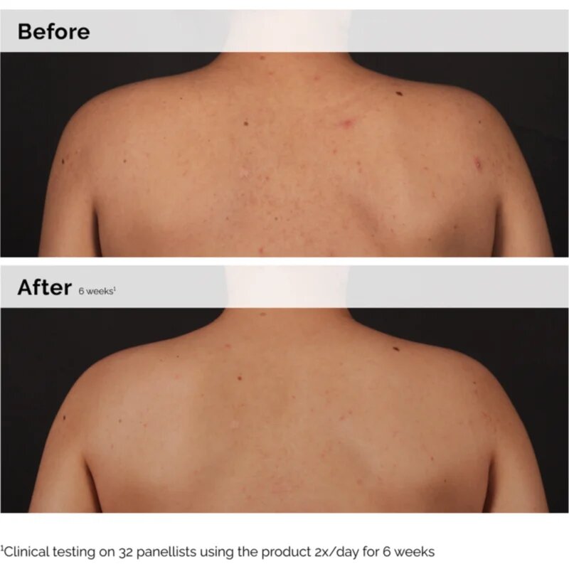 The Ordinary Salicylic Acid 0.5% Body Serum zdokonalující tělové sérum s kyselinou salicylovou 240 ml