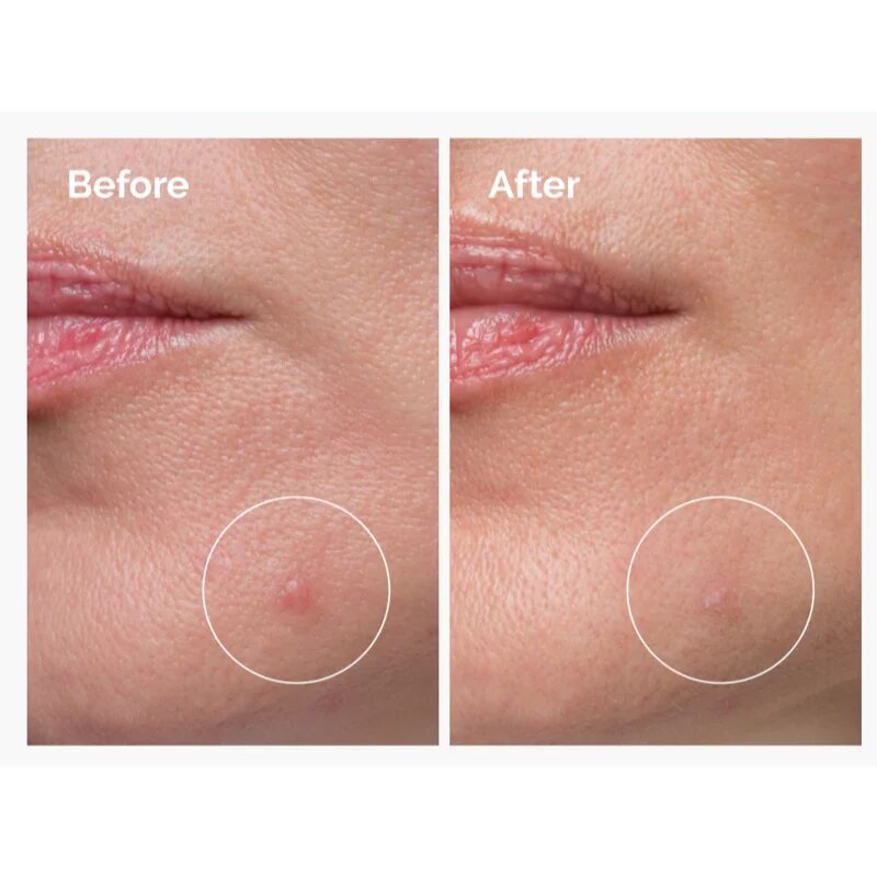 The Ordinary Sulfur 10% Powder-to-Cream Concentrate lokální péče proti akné 5 g